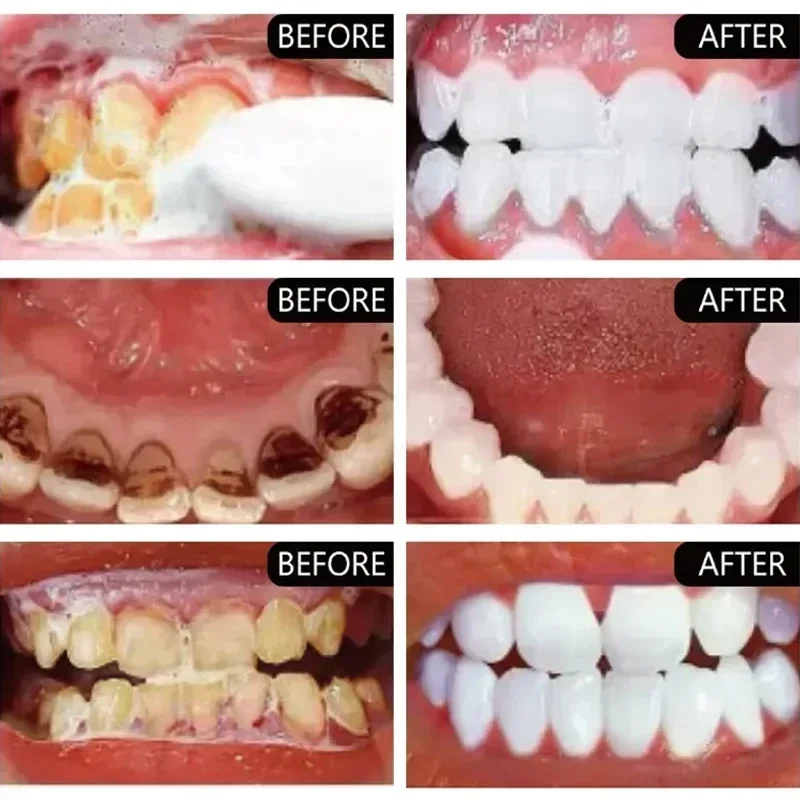 Fast Remove Smoke Stains Tooth - Teeth Whitening Fast ulasan dan harga